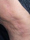 [Bonesmart.org] Has anyone had their incision closed with glue?