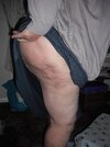 [Bonesmart.org] Has anyone had their incision closed with glue?