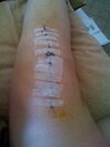 [Bonesmart.org] Op was off - and then on again!