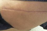 [Bonesmart.org] Hippies scars - post your badges of honor here: NO CHIT-CHAT HERE PLEASE