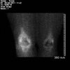 [Bonesmart.org] The Story of My Knees Part 1