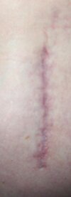 [Bonesmart.org] Hippies scars - post your badges of honor here: NO CHIT-CHAT HERE PLEASE