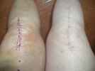 [Bonesmart.org] knee scars only