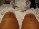 [Bonesmart.org] knee scars only