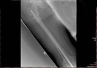 [Bonesmart.org] Long ride to a successful Fusion