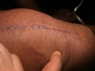 [Bonesmart.org] Will new knees be good enough?