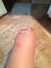 [Bonesmart.org] New Left Knee . . . Check!!