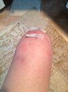 [Bonesmart.org] New Left Knee . . . Check!!