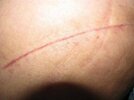 [Bonesmart.org] Hippies scars - post your badges of honor here: NO CHIT-CHAT HERE PLEASE