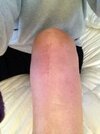 [Bonesmart.org] New Left Knee . . . Check!!