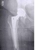 [Bonesmart.org] DallasSarah post op update!