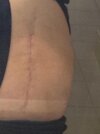 [Bonesmart.org] DallasSarah post op update!