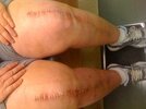 [Bonesmart.org] La's new knees (recovery diary)