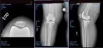 [Bonesmart.org] May Have Loosening Of My Implant!
