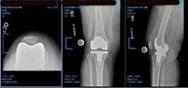 [Bonesmart.org] May Have Loosening Of My Implant!