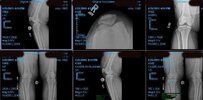 [Bonesmart.org] May Have Loosening Of My Implant!