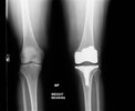 [Bonesmart.org] Revision Complete, recovery continues