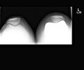 [Bonesmart.org] Revision Complete, recovery continues