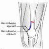 [Bonesmart.org] Minimally Invasive TKR