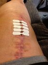 [Bonesmart.org] Story of My Knees by RestAssured: Pt 3