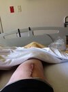 [Bonesmart.org] Story of My Knees by RestAssured: Pt 3