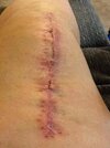 [Bonesmart.org] Story of My Knees by RestAssured: Pt 3