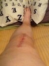 [Bonesmart.org] Story of My Knees by RestAssured: Pt 3
