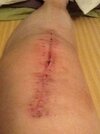 [Bonesmart.org] Story of My Knees by RestAssured: Pt 3