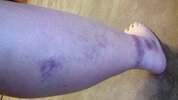 [Bonesmart.org] Story of My Knees by RestAssured: Pt 3