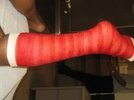 [Bonesmart.org] Vicki's Venture - a new knee 7/30/12