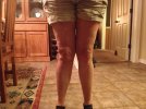 [Bonesmart.org] How much do you tell to someone considering surgery?