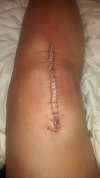 [Bonesmart.org] Two TKR in two weeks---let the fun begin!