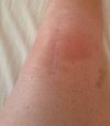 [Bonesmart.org] Onwards and upwards - my journey continues