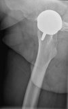 My Right Hip from another angle which was  resurfaced  in the UK 2009.jpg