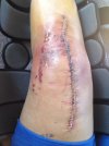 [Bonesmart.org] Knee from hell