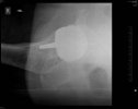 [Bonesmart.org] Resurfacing problem I have had