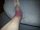 [Bonesmart.org] Red dots...Do I have an allergy to my TKR??