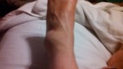 [Bonesmart.org] Roofmaster's new hips, part one