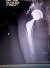 [Bonesmart.org] Roofmaster's new hips, part one