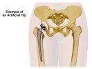 [Bonesmart.org] Scared newbie... Hip is shot. What if it doesn't work!!??