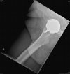 [Bonesmart.org] Resurfacing problem I have had