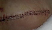 [Bonesmart.org] Starting to wish I'd never had a knee replacement