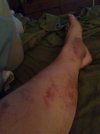 [Bonesmart.org] Starting to wish I'd never had a knee replacement