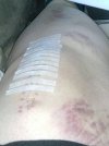 [Bonesmart.org] Starting to wish I'd never had a knee replacement