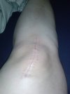 [Bonesmart.org] Starting to wish I'd never had a knee replacement