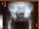 [Bonesmart.org] LTHR with bone graft March 19, 2012