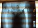 [Bonesmart.org] LTHR with bone graft March 19, 2012