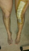[Bonesmart.org] I'm Here.... PKR left lateral complete!