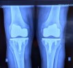 [Bonesmart.org] New life with new knees at 85!