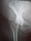 [Bonesmart.org] Riding the Recovery Roller Coaster